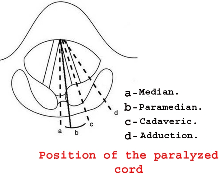 position of paralysed cord